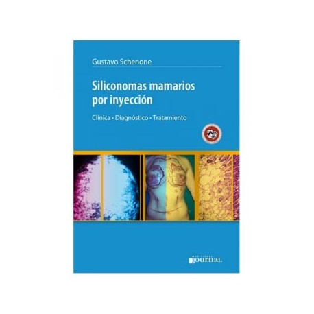Siliconomas Mamarios por Inyección (Journal)