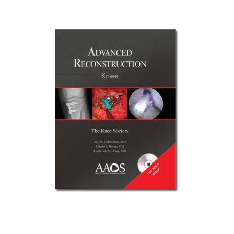 Advance Reconstruction: Knee